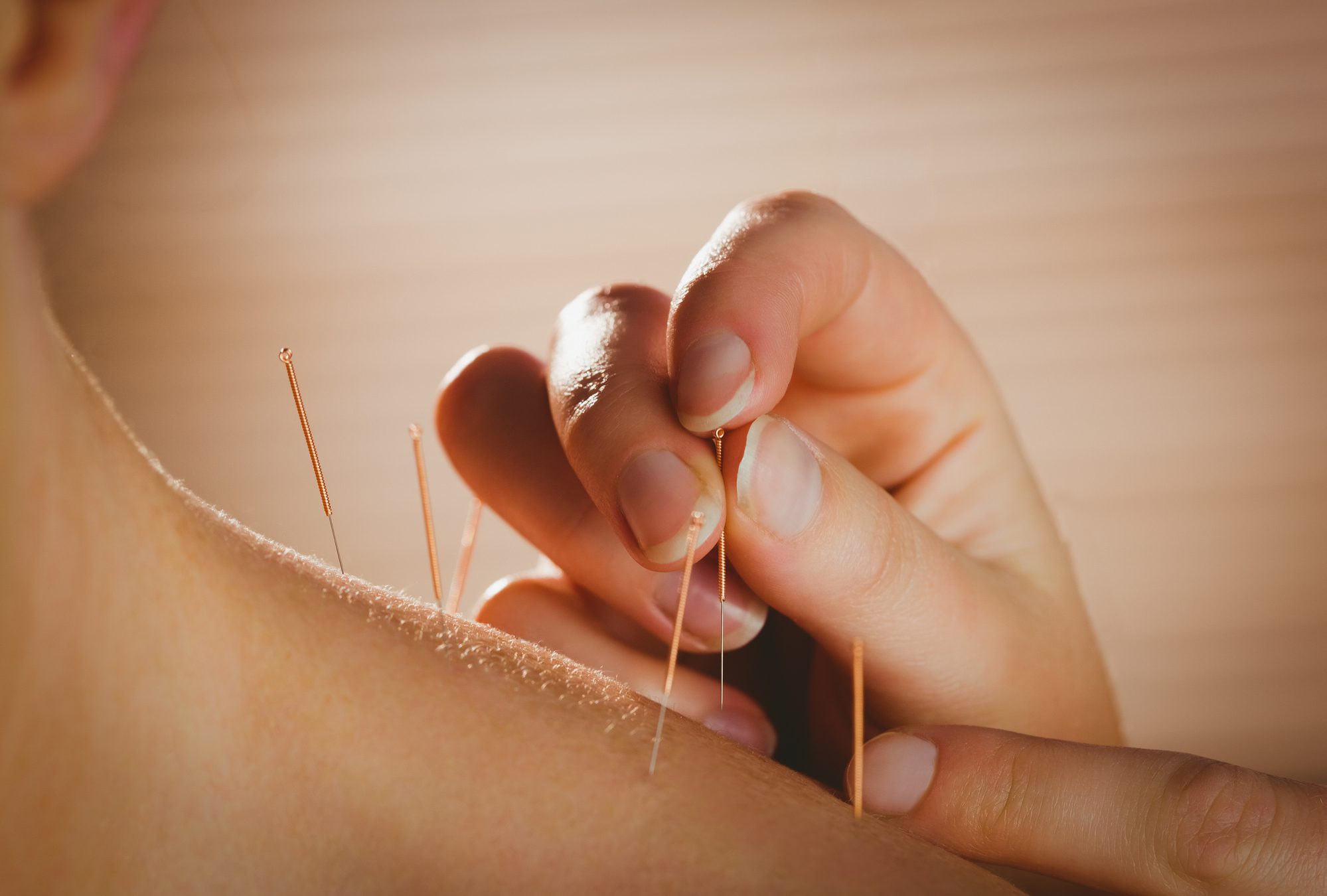 Using acupuncture can be a great natural depression remedy